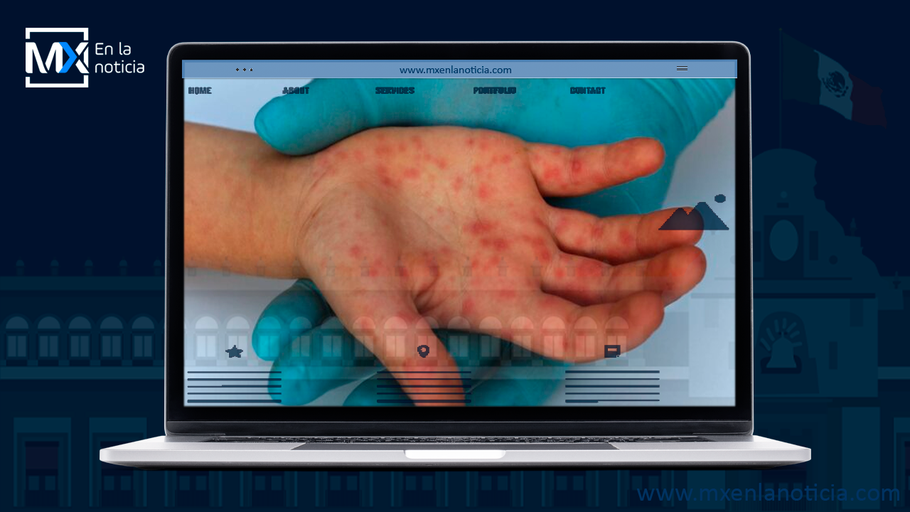 Rara e inusual enfermedad ataca a Reino Unido: ya hay 7 casos de viruela símica